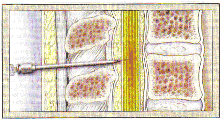 Espinal epidural combinada (CSE) Tcnica