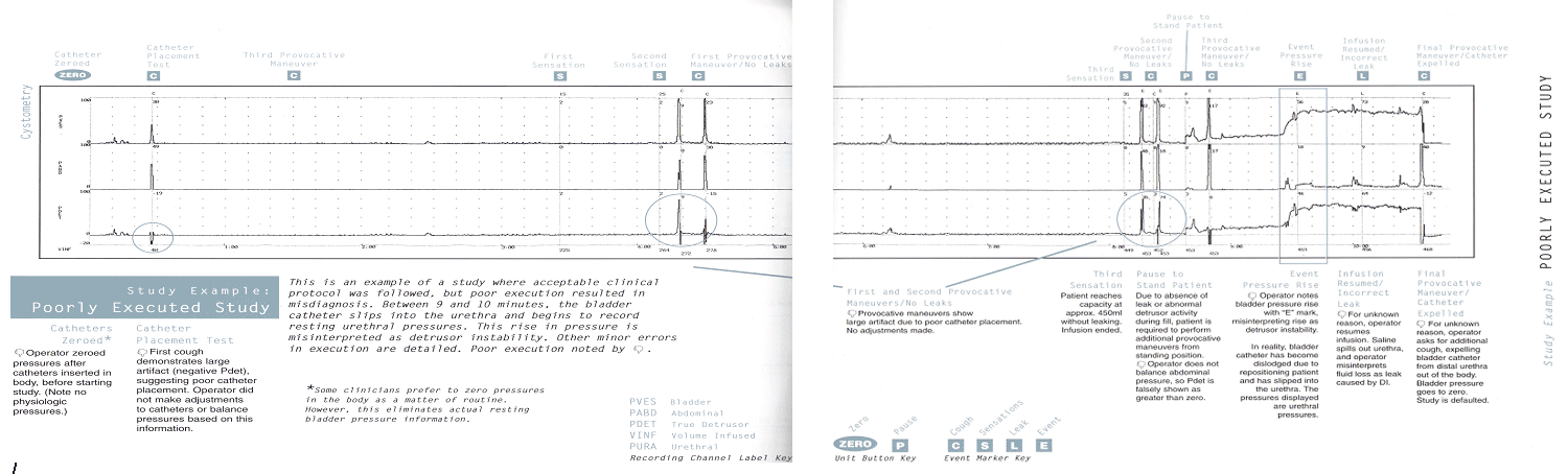 Normal Uroflow Chart