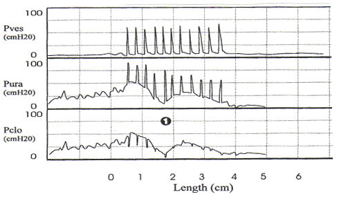 Stress urethral closure pressure measurement with primary urethral instability. Note the small magnitude fluctuations in urethral pressure before coughing and the decrease in the urethral pressure shortly after initiation of coughing (1). This should not be mistaken for sphincteric deficiency.