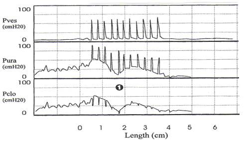 Stress urethral fermeture primaire de mesure de pression urtrale, l'instabilit. Note de la faible amplitude des fluctuations de pression dans l'urtre avant la toux et la diminution de la pression urtrale, peu aprs l'ouverture de la toux (1). Cela ne doit pas tre confondu avec sphinctrienne carence.