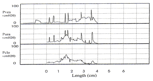 Stress fermeture de la mesure de la pression urtrale avec hyperrflexie dtrusor. Notez la frquence des contractions vsicales involontaires qui font de l'interprtation de cette tude difficile.