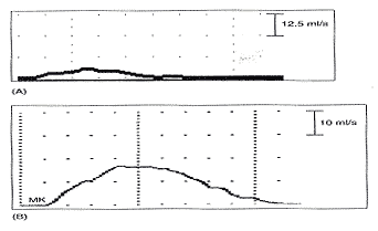 Effet sur uroflow de cathter 7F urodynamique. Il existe trois sources potentielles d'erreur dans le uroflow obtenus avec le cathter 7F urodynamique en place. Tout d'abord, le patient avait une forte envie de vide et annul avec seulement 104 ml dans la vessie, le volume trop faible pour une valuation prcise. Deuximement, le cathter lui-mme causer une obstruction mai, et enfin, le patient mai de ne pas suffisamment se dtendre dans le cadre de l'examen urodynamique. (A) Uroflow obtenus avec cathter 7F urodynamique en place. VIDE = 6/78/26. (B) Uroflow obtenu avant sans une tude urodynamique urethral cathter en place NULLES = 16/190/5