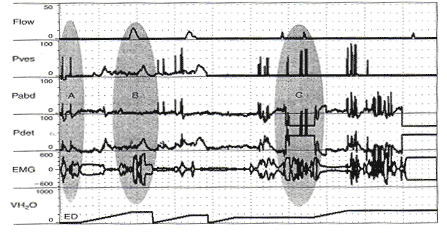 Unequal pressure transmission (and a potpourri of other artifacts). Before bladder filling is begun, when the patient coughs, vesical pressure rises much higher than abdominal pressure and detrusor pressure is artifactually elevated [shaded oval A). Thereafter, whenever there is a rise in Pves > Pabd, Pdet artifactually rises. In the area marked by the shaded oval B, she is incontinent during an involuntary detrusor contraction that is barely measurable. In the midst of the contraction, she was asked to stop. She contracts her sphineter (Increased EMG activity), interrupts the stream (Q falls to 0), and Pdet rises as the bladder is contracting against the closed sphincter. The bladder is refilled and she is asked to repeatedly cough. Each time, Pves > Pabd and Pdet is artifactually increased. During one of the coughs, the Pabd catheter is expelled and Pabd falls well below 0, artifactually raising Pdet (Shaded oval C).