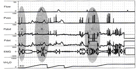 La desigualdad en la transmisin de presin (y un popurr de otros artefactos).Antes de comenzar el llenado vesical, cuando el paciente tose, la presin vesical se eleva mucho ms alto que la presin abdominal y la presin del detrusor es elevada artifactually [sombra ovalada A).Posteriormente, cada vez que hay un aumento de la Pves> Pabd, PDET artifactually sube.En la zona marcada por la sombra oval B, ella es una incontinencia durante la contraccin involuntaria del detrusor que es apenas mensurables.En medio de la contraccin, se le pidi que se detenga.Los contratos que su sphineter (aumento de la actividad EMG), interrumpe el flujo (Q corresponde a 0), y PDET sube como la vejiga se contrae contra el cierre del esfnter.La vejiga es recargado y que se le pide repetidamente tos.Cada vez, Pves> Pabd y PDET es artifactually aumentado.Durante una de las toses, el Pabd catter es expulsado y Pabd cae muy por debajo de 0, artifactually recaudacin PDET (Sombreado valo C). 