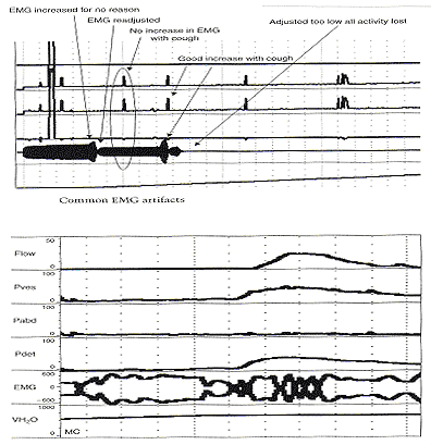 Notez que ce patient a subi une contraction dtrusor et normal uroflow. Tant le dtrusor et contraction uroflow ont courbes lisses encore il ya plusieurs augmentations de l'activit EMG suggrent que les contractions du sphincter stri urtral. Si ces contractions du sphincter, il devrait tre synchrone des changements dans la pression et uroflow dtrusor.