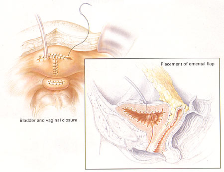 Rparation Abdominale