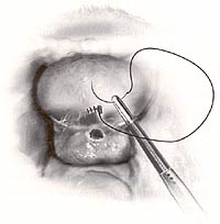 Abdominal Repair