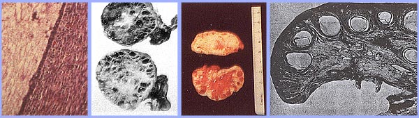 polycystic ovarian syndrome