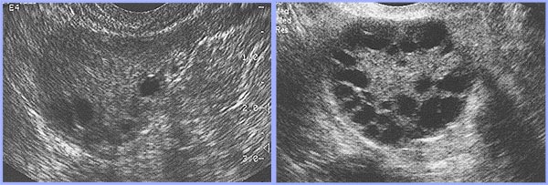polycystic ovarian syndrome