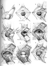 Detailed repair of vesicovaginal fistula