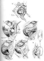 Detailed repair of vesicovaginal fistula