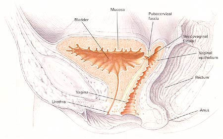 Vesicovaginal fistula