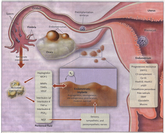 Pathophysiology of Pain and Infertility Associated with Endometriosis