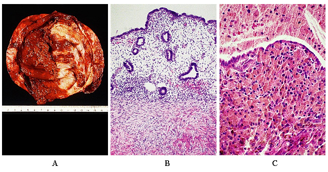 Pathophysiology of Pain and Infertility Associated with Endometriosis