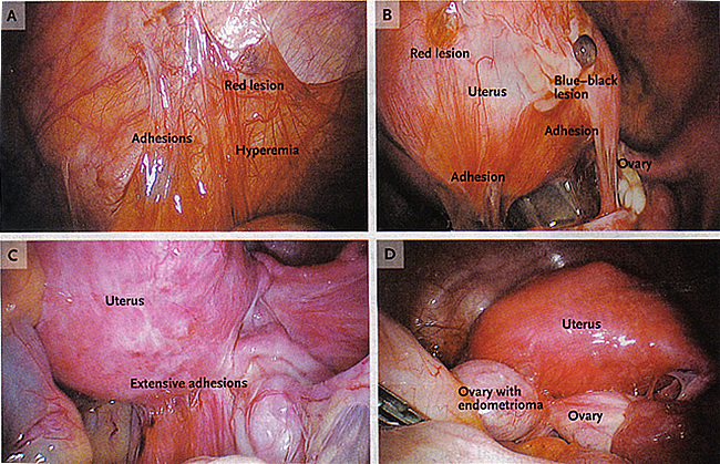 Pathophysiology of Pain and Infertility Associated with Endometriosis