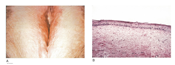 Figure 3 Lichen Sclerosus