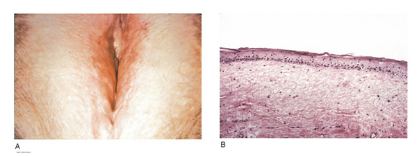 Stichting Lichen Sclerosus – Stichting Lichen Sclerosus