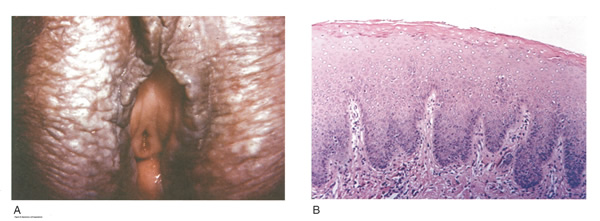 Figure 6 Squamous Cell Hyperplasia