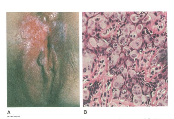 Figure 7 Paget's Disease of Vulva