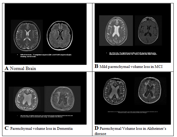 MRI image of cerebral atrophy and other abnormalities that are associated with decreased cognition or dementia