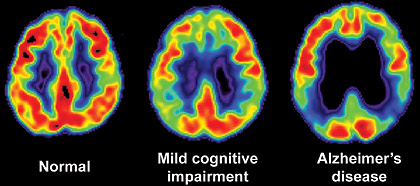 Positron emission tomography and computerized tomography scan of brain and Alzheimers disease