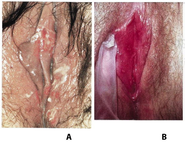 Vagina herpes an der Herpes genitalis: