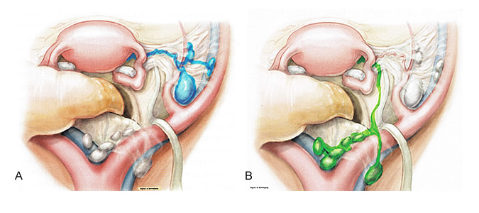 Sentinel Lymph Nodes Diagram Pelvic Area