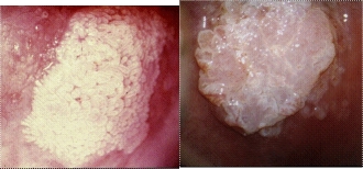 Adnocarcinome in situ (AIS)