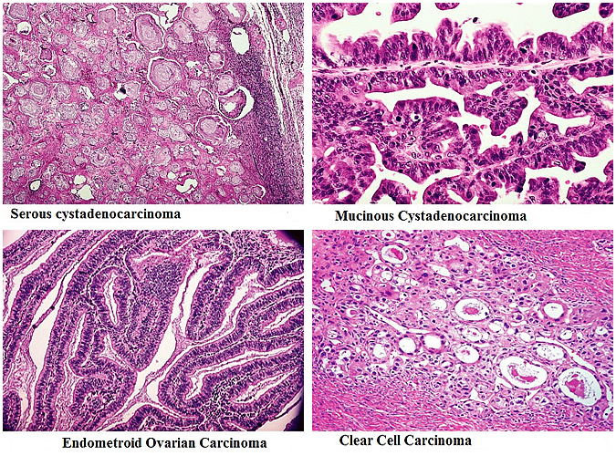 Histology of Ovarian Cancer