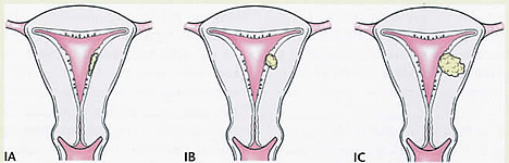 Uterine Cancer Diagram Stage I