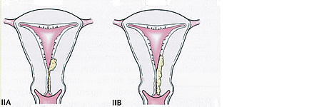 Uterine Cancer Diagram Stage II