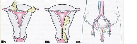 Uterine Cancer Diagram Stage II