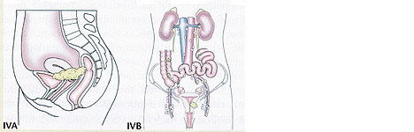 Uterine Cancer Diagram Stage II