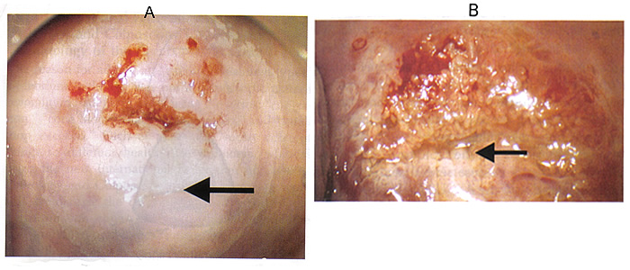 Fig. 1 Images de rsultats anormaux colposcopie