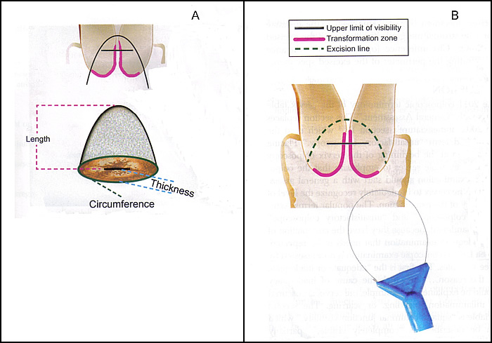 Fig. 1 Images of abnormal colposcopic findings