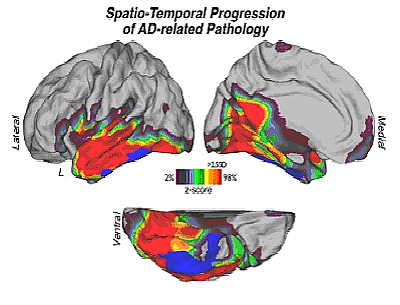 PET imaging in Alzheimer disease patients