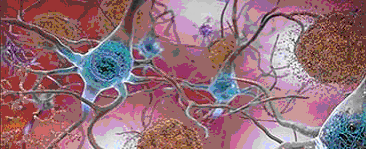 drawing showing accumulation of amyloid proteins and plaques in the brain