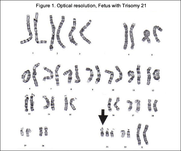 Figure 1. Optical Resolution, Fetus with Trisomy 21