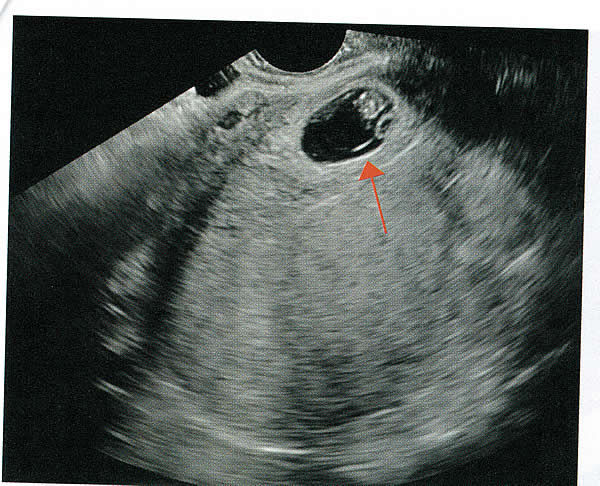 Normal first trimester ultrasound