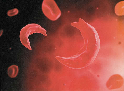 image, microscopic view of sickled red blood cell