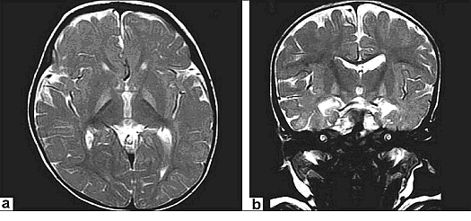 Figure 3. a and b: Axial T2WIs and coronal T2WIs