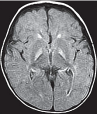 Figure 4. Axial FLAIR showing bilateral, symmetrical hyperintensities in the globus pallidus