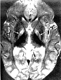 Figure 5. Magnetic resonance of 21-month-old with kernicterus.