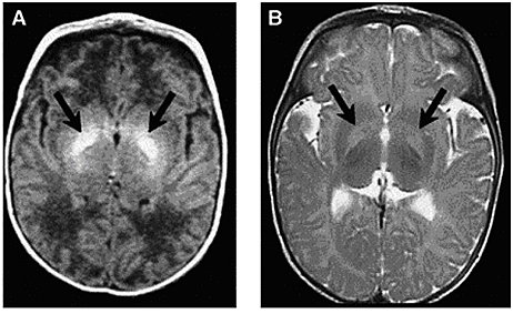 Figure 4. Axial MRI of bilateral hyperintense lesions