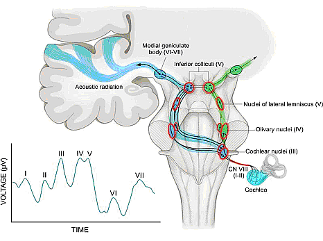 Figure 5. The auditory pathway and normal auditory brainstem response