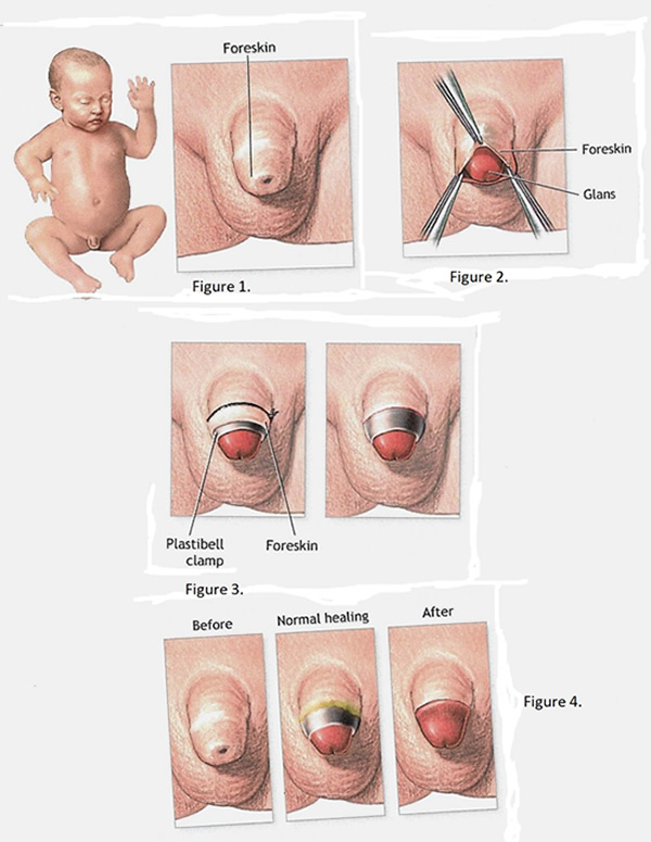 Procédure après la circonision - Guérison du bébé - Gentle Procedures NB