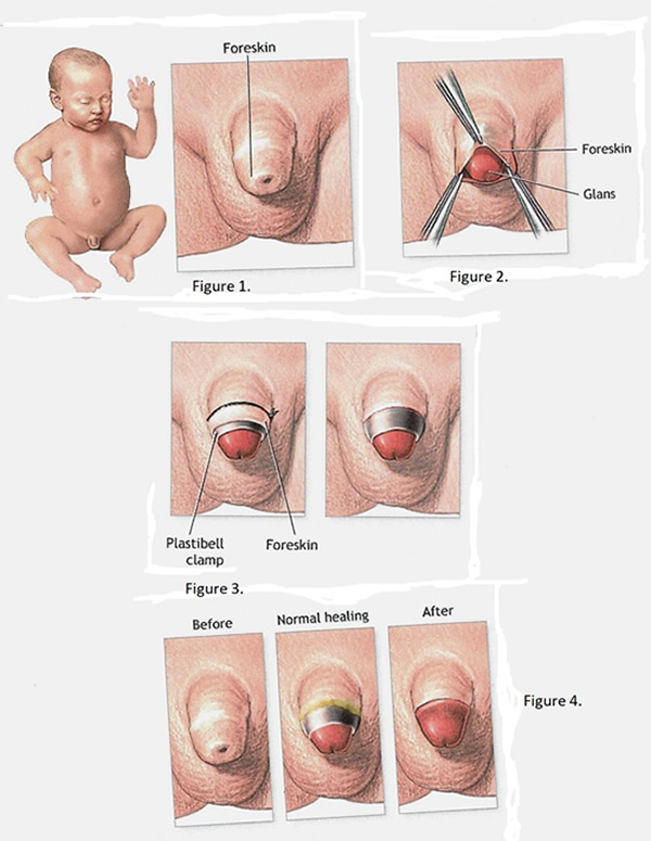 picture Circumcision with Plastibell clamp