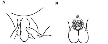 picture of penile nerve block technique