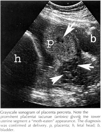 placenta accreta histology