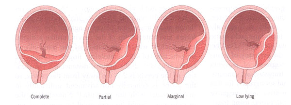 Types of placenta previa.